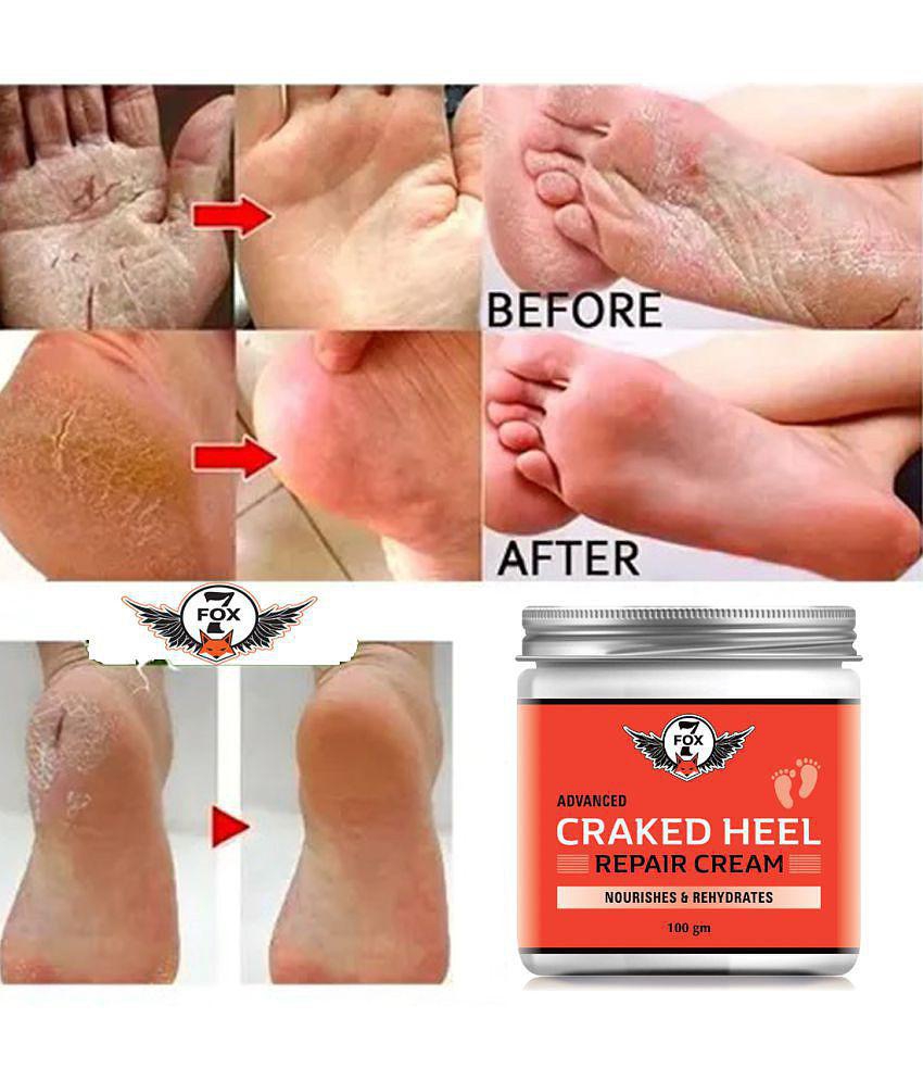 7 FOX Cracked Heel Repair Specialist Cream Smooth Feet, Foot Cream ( 10 mL )