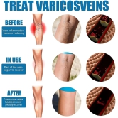 Vein Healing Varicose Veins Treatment Spray Pack of 2