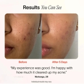 PureSpot™? - 3-Minute Pimple Spot Treatment