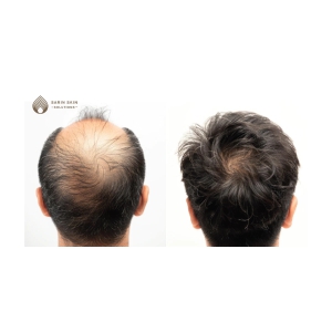 Hair Transplant By Dr. Ankur Sarin-2500 Follicles