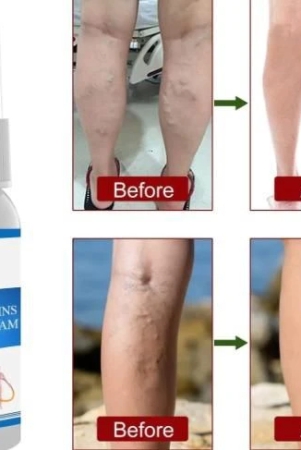 varicose-vein-cream-spray-varicose-vein-legs-and-varicose-vein-swelling-l3g1-pack-of-2