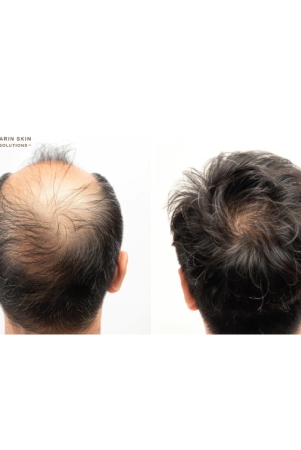 hair-transplant-by-dr-ankur-sarin-4000-follicles