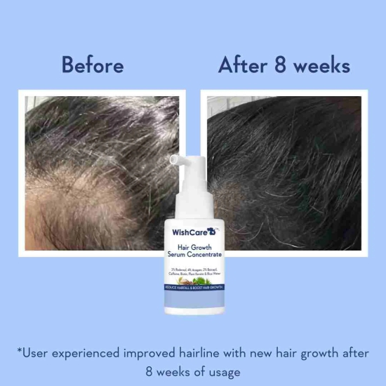 Hair Growth Serum Concentrate With 3% Redensyl, 4% Anagain, Rice Water, Biotin-6 Month Pack (Qty: 6)