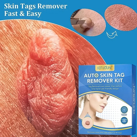 Skin Tag Remover Kit, Skin Tag Remover Kit 2 in 1 Skin Tag Removal with Auto Skin Tag Remover