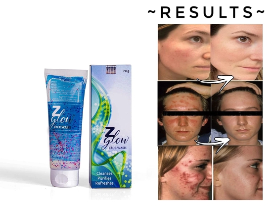 Z Glow facewash for oily & acne prone skin, 70gm