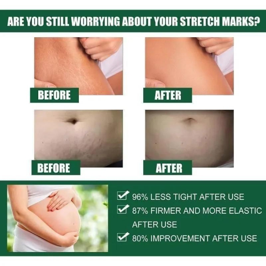 Stretch Mark Cream by Kurai - Perfect for Pregnancy and Postpartum Care